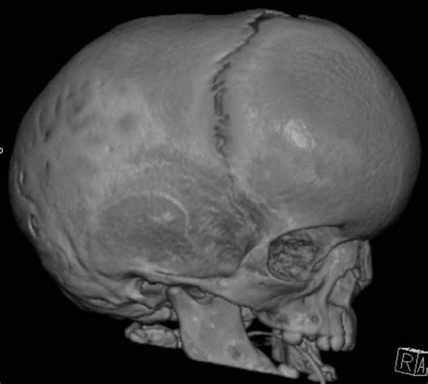 Life As A Pediatric Nurse: Scaphocephaly with Craniofacial Surgery