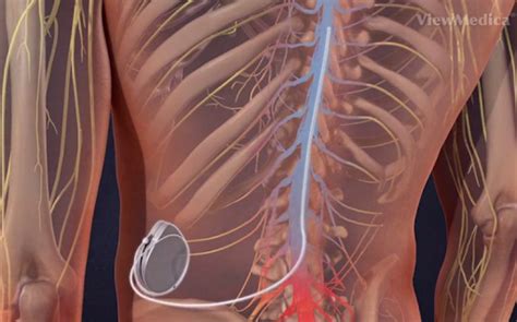 Intrathecal Pain Pump Doctors In Kansas City Mo