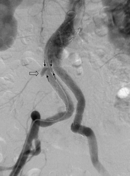 Endoleaks Classification Diagnosis And Treatment Radiology Key