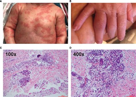 Frontiers Case Report Infantile Urticaria As A Herald Of Neonatal