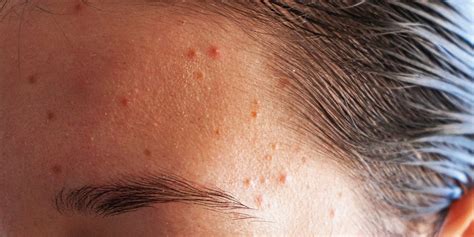 Forehead Acne The Causes And Best Treatments According To Derms