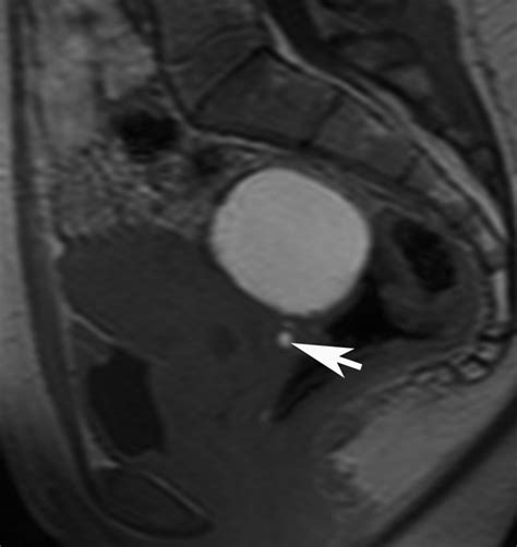 Vaginal Endometriosis Sagittal T1 Weighted Mri Showing Hyperintense