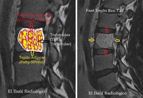 HEMANGIOMA SPINE MRI T1 T2 - Wroc?awski Informator Internetowy - Wroc ...