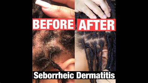 How I Manage Seborrheic Dermatitis With Locs Youtube