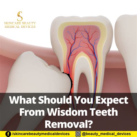 What Should You Expect From Wisdom Teeth Removal