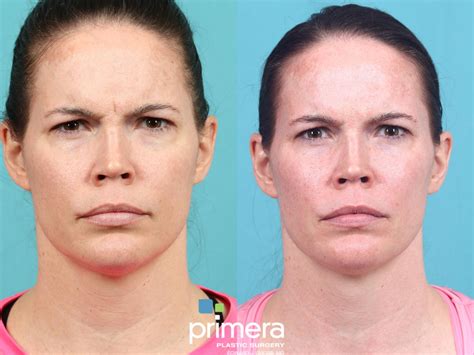 Botox Cosmetic Before And After Pictures Case Orlando Florida