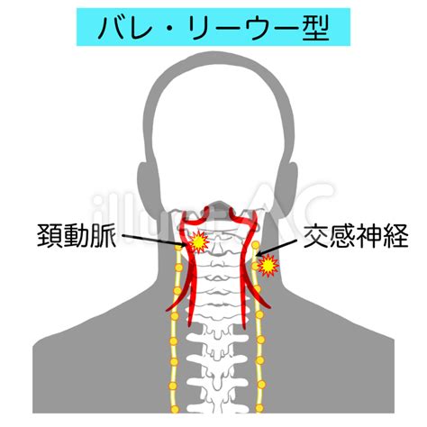 むちうち損傷 バレ・リーウー型イラスト No 22948641｜無料イラスト・フリー素材なら「イラストac」