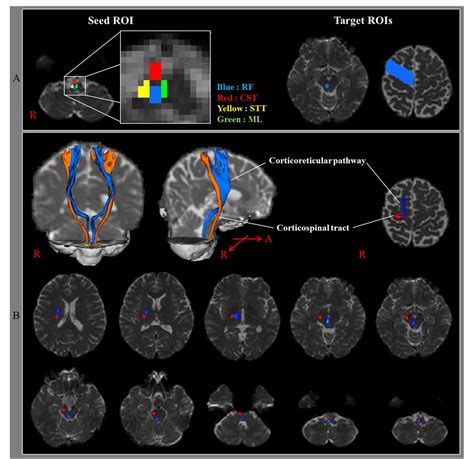 Pdf Corticoreticular Tract In The Human Brain A Mini Review Semantic Scholar