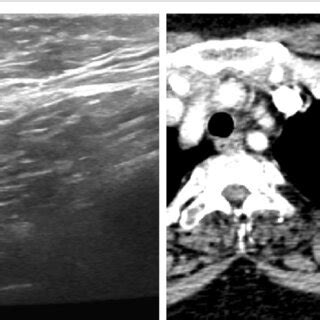 A 70 Year Old Female With Left Pathologically Proven Metastatic