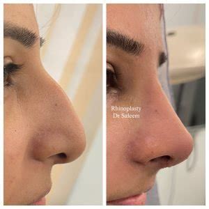 Rhinoplasty Cost In Pakistan Lahore Cosmetic Nose Job Surgery