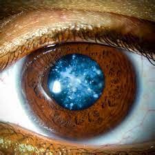 Snowflake Cataract: Meaning, Symptoms, Causes And Tips