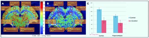 Rcbf Values Of The Hippocampus And Cortex Region Images Of Control