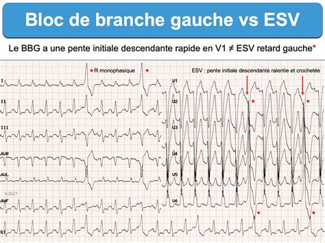 Bloc De Branche 3 Gauche Complet E Cardiogram