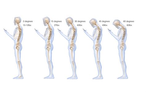 Forward Head Posture Back To Active Sports And Spinal Macquarie Park