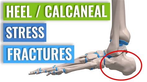 Heelcalcaneal Stress Fracture Causes Symptoms And Treatment Youtube