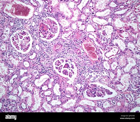 Polyarteritis nodosa, light micrograph Stock Photo - Alamy