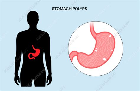 Stomach Polyps Illustration Stock Image F036 5554 Science Photo