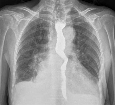 Barium Swallow Showing The Compression In The Oesophagus At The Level