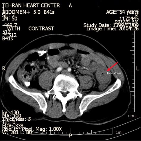 Axial Abdominal Ct With Iv Contrast Circumferential Descending Colon