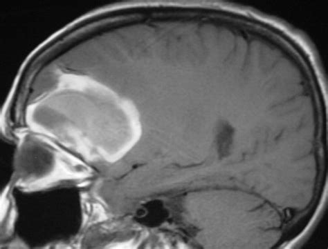 Intracranial Lesions With High Signal Intensity On T1 Weighted Mr