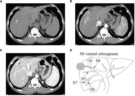 Frontiers Imaging Features Of Hepatocellular Carcinoma With Bile Duct