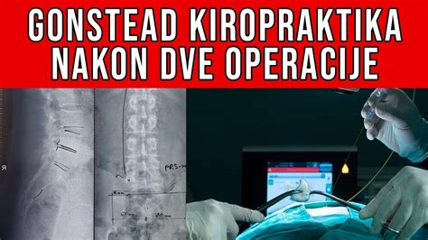 Kiropraktika Nakon Dve Operacije Diskus Hernije Diskus Hernija L4L5