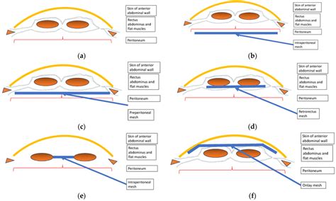 Schematic diagram of anatomic abdominal incisional hernia mesh ...