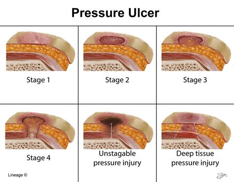 Pressure Ulcers Graphic Images For Medical Professionals Only