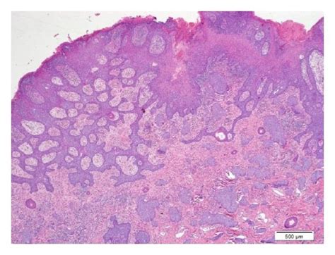 A And B Skin And Left Scrotum Involved By Extramammary Paget’s Download Scientific