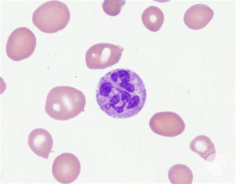 Hypersegmented Neutrophil