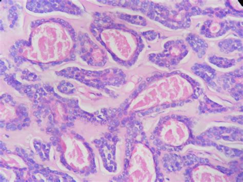 Adenoid Cystic Carcinoma Histopathologyguru