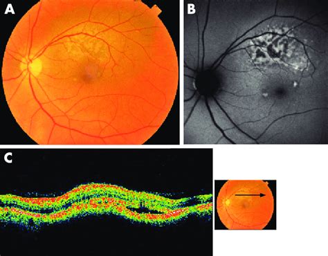 Choroidal Nevus With Lipofuscin