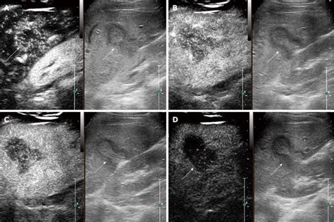 Contrast Enhanced Ultrasound Feature Of Hepatic Epithelioid Download Scientific Diagram