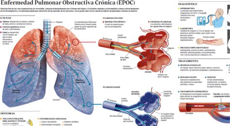 Enfermedad Pulmonar Obstructiva Cr Nica S Ntomas Diagn Stico Y