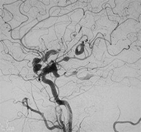 Imaging Spectrum Of Cns Vasculitis Radiographics