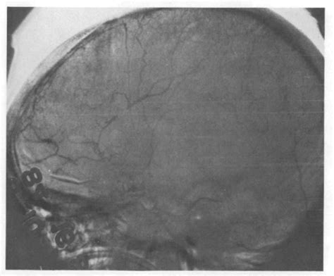 Figure 1 From Dilated Episcleral Arteries — A Significant Physical