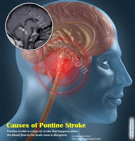 Causes Of Pontine Stroke Brain System Brain Stem How To Better Yourself