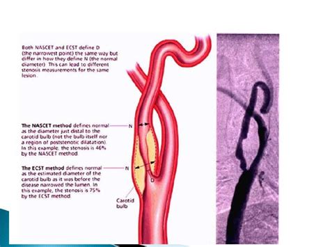 CAROTID ARTERY STENOSIS