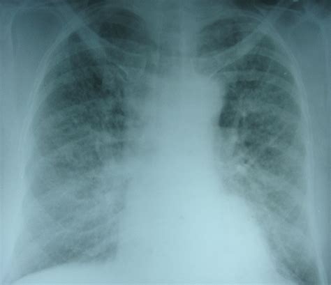 Pulmonary edema – X-ray chest PA view – All About Cardiovascular System ...