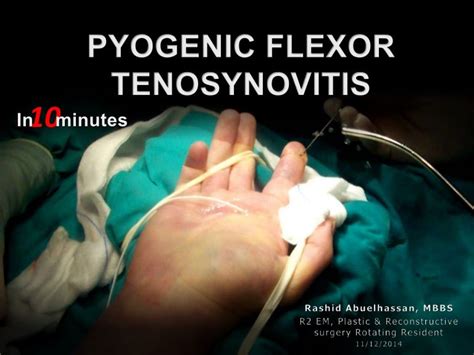 Flexor Tenosynovitis