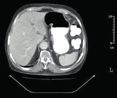 Computed Tomography Scan Of The Abdomen Months After Completion Of