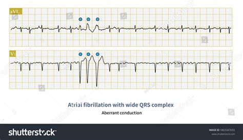 Atrial Fibrillation Wide Qrs Complex Common Stock Illustration