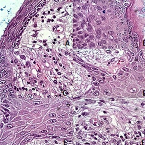 Photomicrography Of The Poorly Differentiated Invasive Squamous Cell Download Scientific