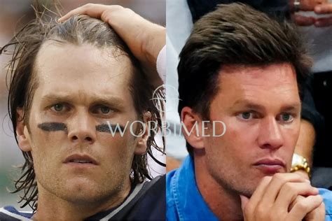 Tom Brady Hair Transplant l Before and After