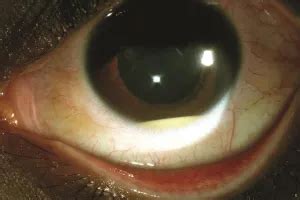 Hypopyon uveitis - American Academy of Ophthalmology