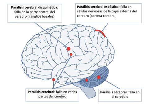 Partes Del Cerebro Que Se Afectan En La Par Lisis Cerebral Y Sus The