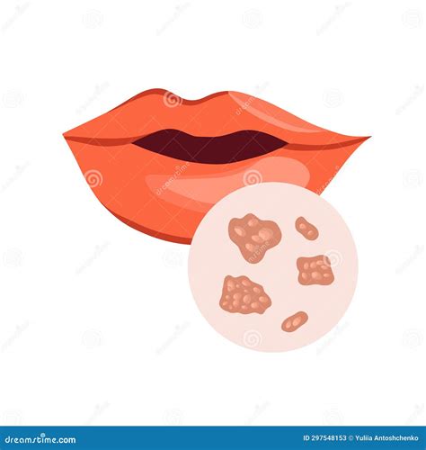 Herpes On Lips Cold Sores Viral Infection Cartoon Vector