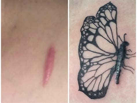 People Are Getting Medical Tattoos To Cover Scars From Surgeries Business Insider