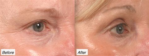 Blepharoplasty In Charleston Dr David Rodwell