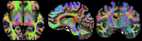 Stunning Brain Images Acquired Using High Resolution Diffusion Weighted